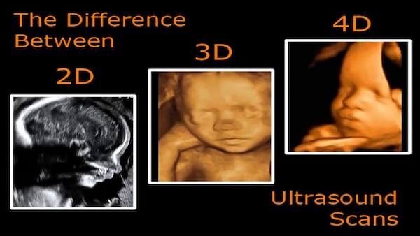 Siêu âm 4D giúp bố mẹ có thể quan sát rõ ràng mọi chuyển động của bé